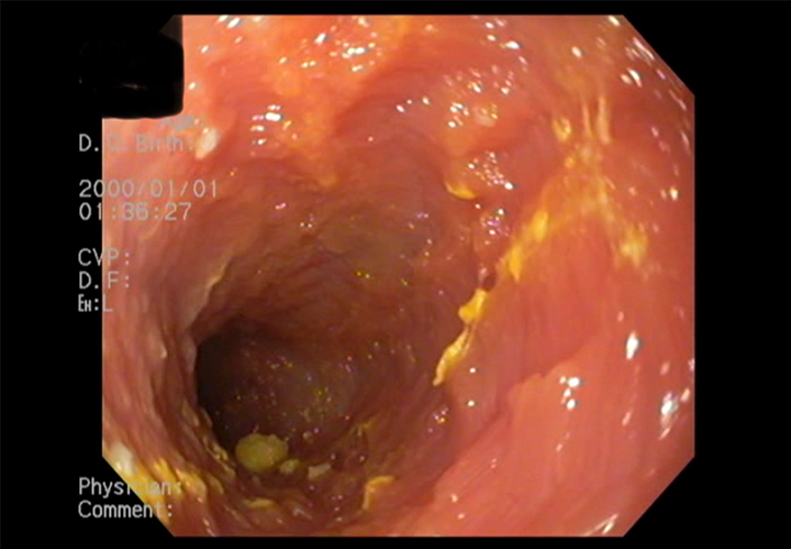 内視鏡での十二指腸粘膜の不整な所見