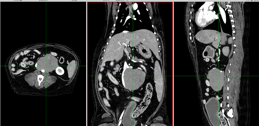 腹腔内腫瘍切除のct画像